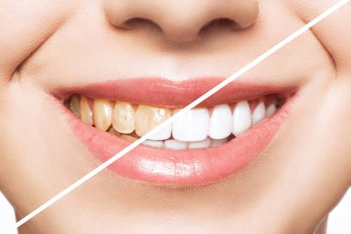 What keeps fake teeth in place